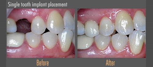 single tooth implant before and after