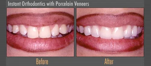 before and after porcelain veneers