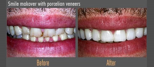 veneers before and after