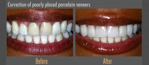 porcelain veneers before and after