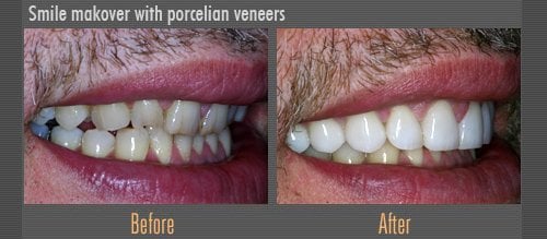 before and after veneers