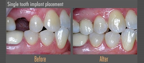before and after dental implants