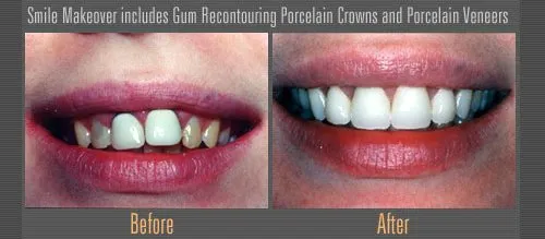 porcelain crowns and veneers before and after