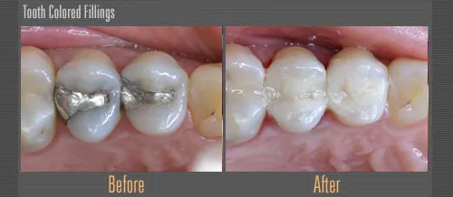 tooth colored fillng before and after