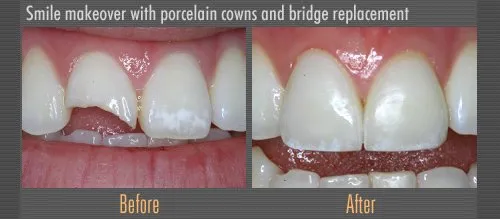 dental bridge before and after