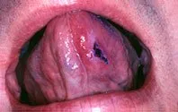 squamous_vizilite