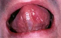 squamous_normal