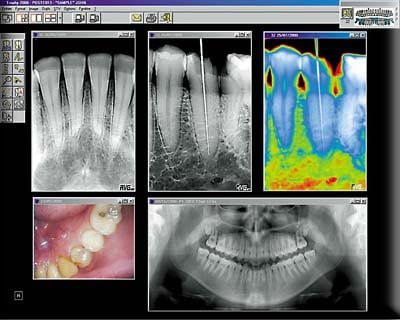 Digital Dental Xray