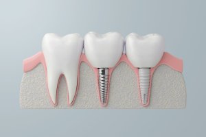 dental implants